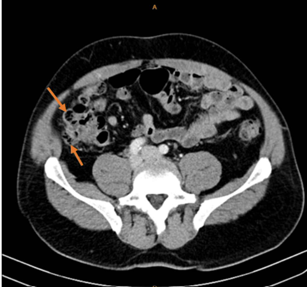 Cureus Right Sided Diverticulitis A Rare Cause Of Right Sided Abdominal Pain