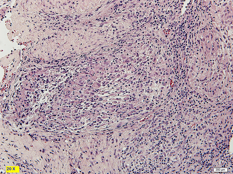 Cureus | A Case of Coexistent Sarcoidosis and Tuberculosis: A ...