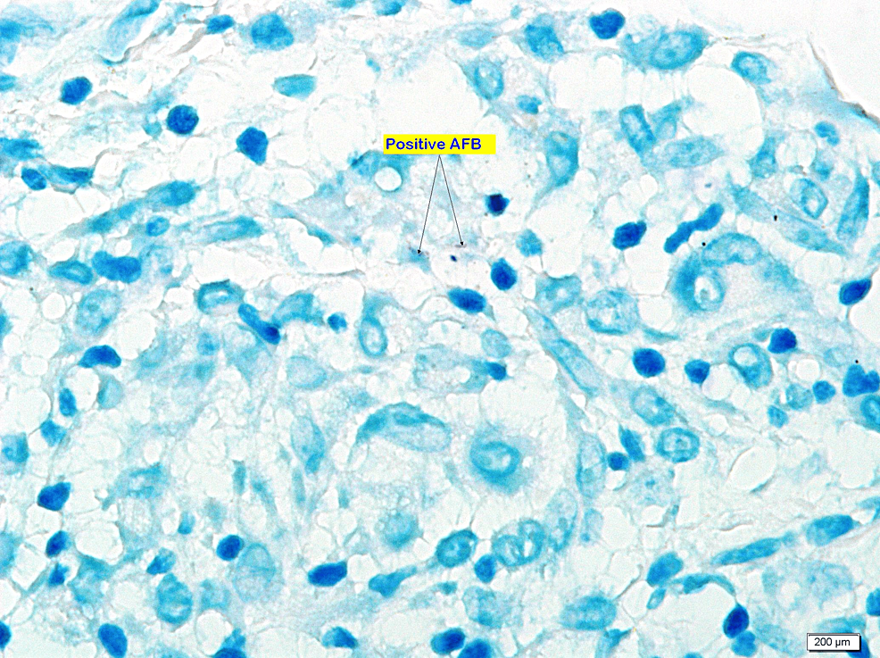 A Case Of Coexistent Sarcoidosis And Tuberculosis: A Diagnostic Dilemma ...