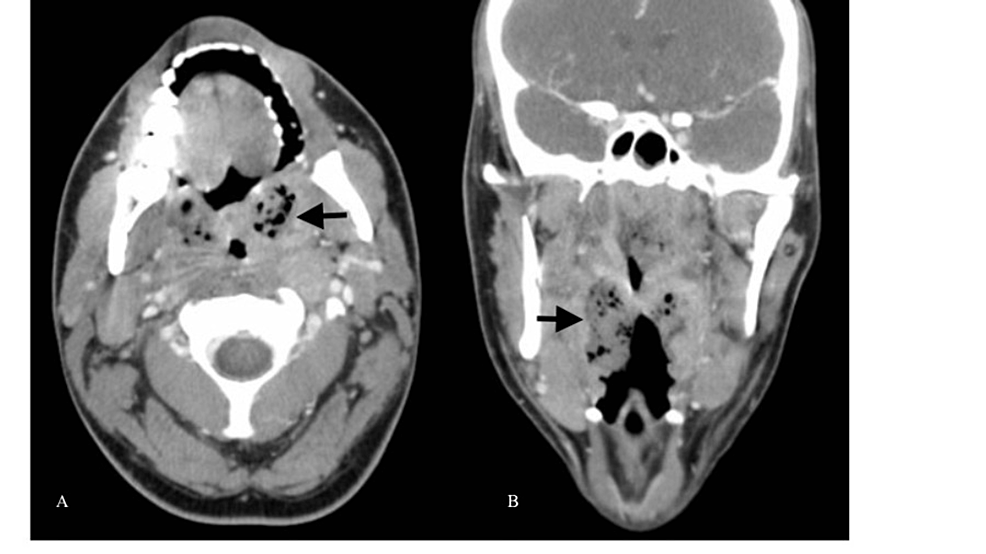 cureus-a-rare-manifestation-of-infectious-mononucleosis-tonsillitis