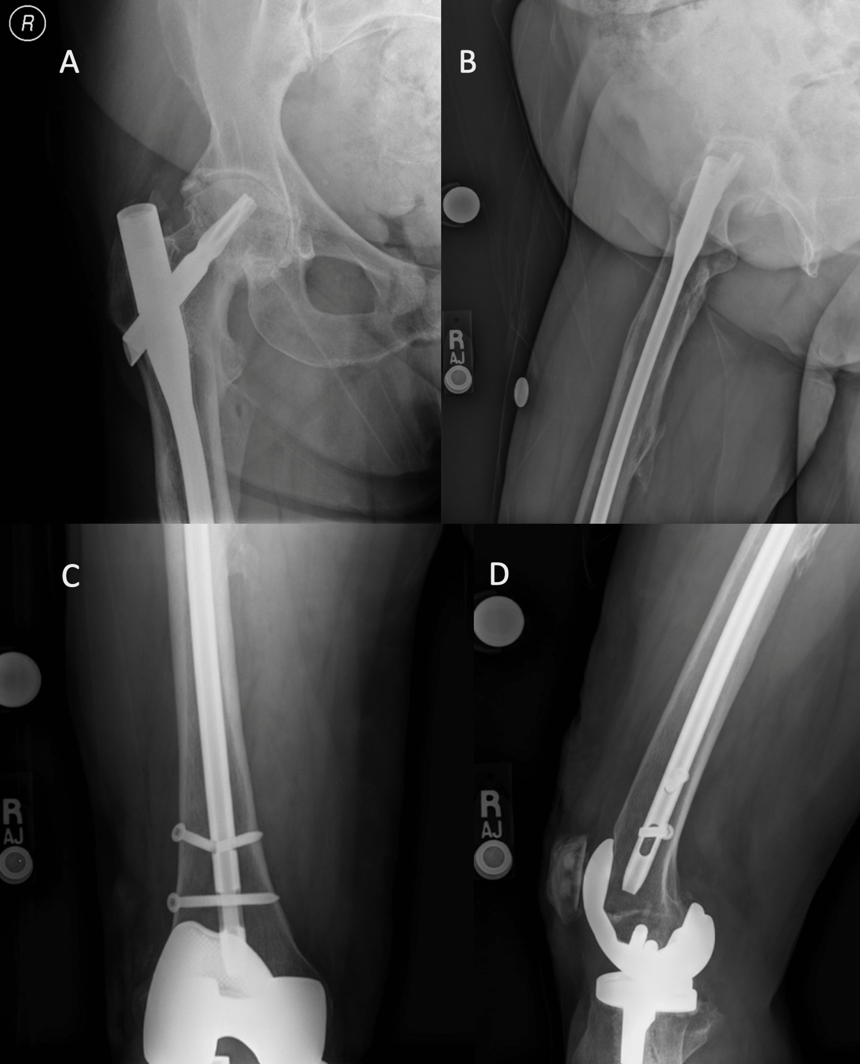 Cureus The Complication of a Retained Broken Distal Interlocking