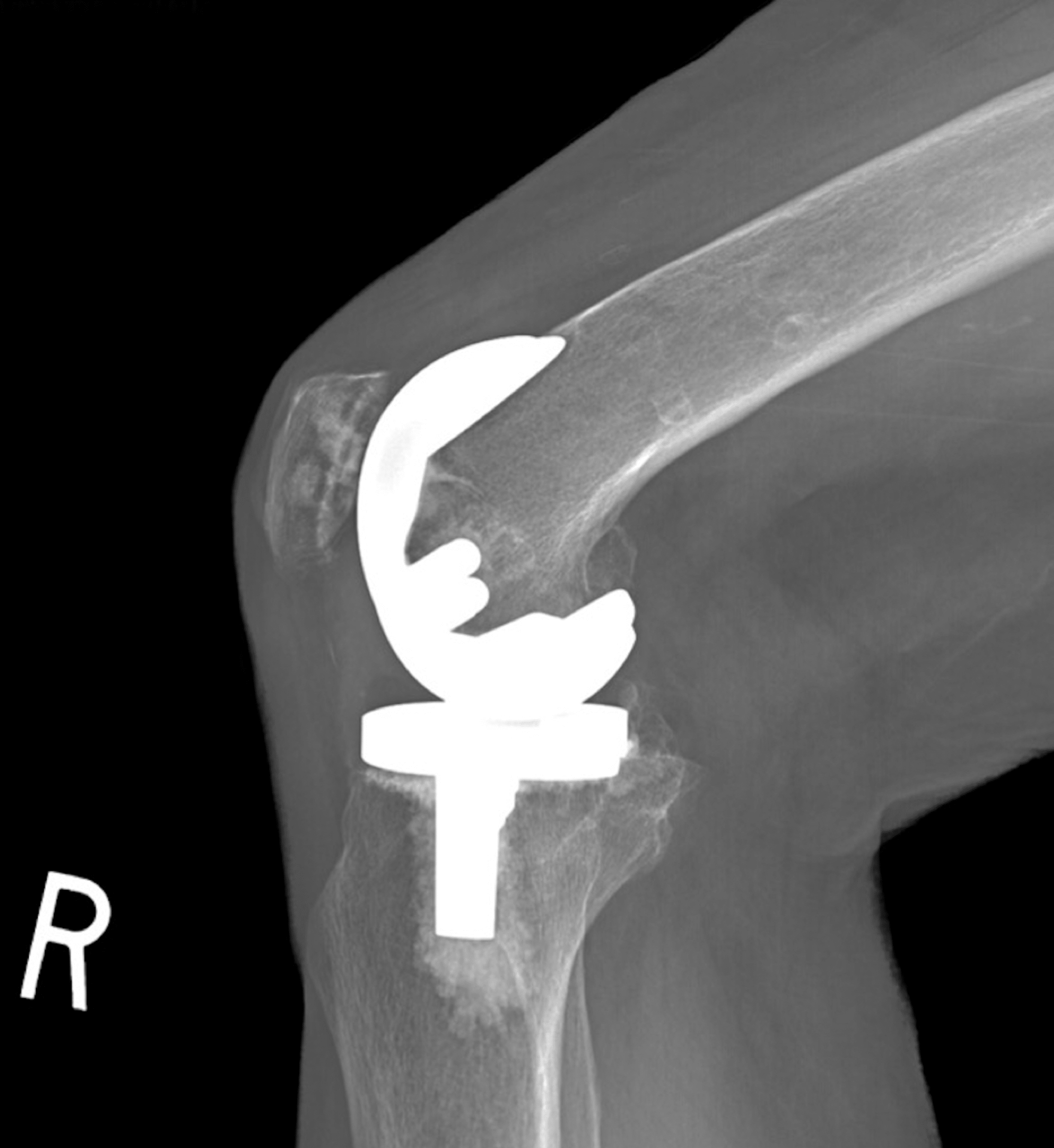 Cureus The Complication of a Retained Broken Distal Interlocking