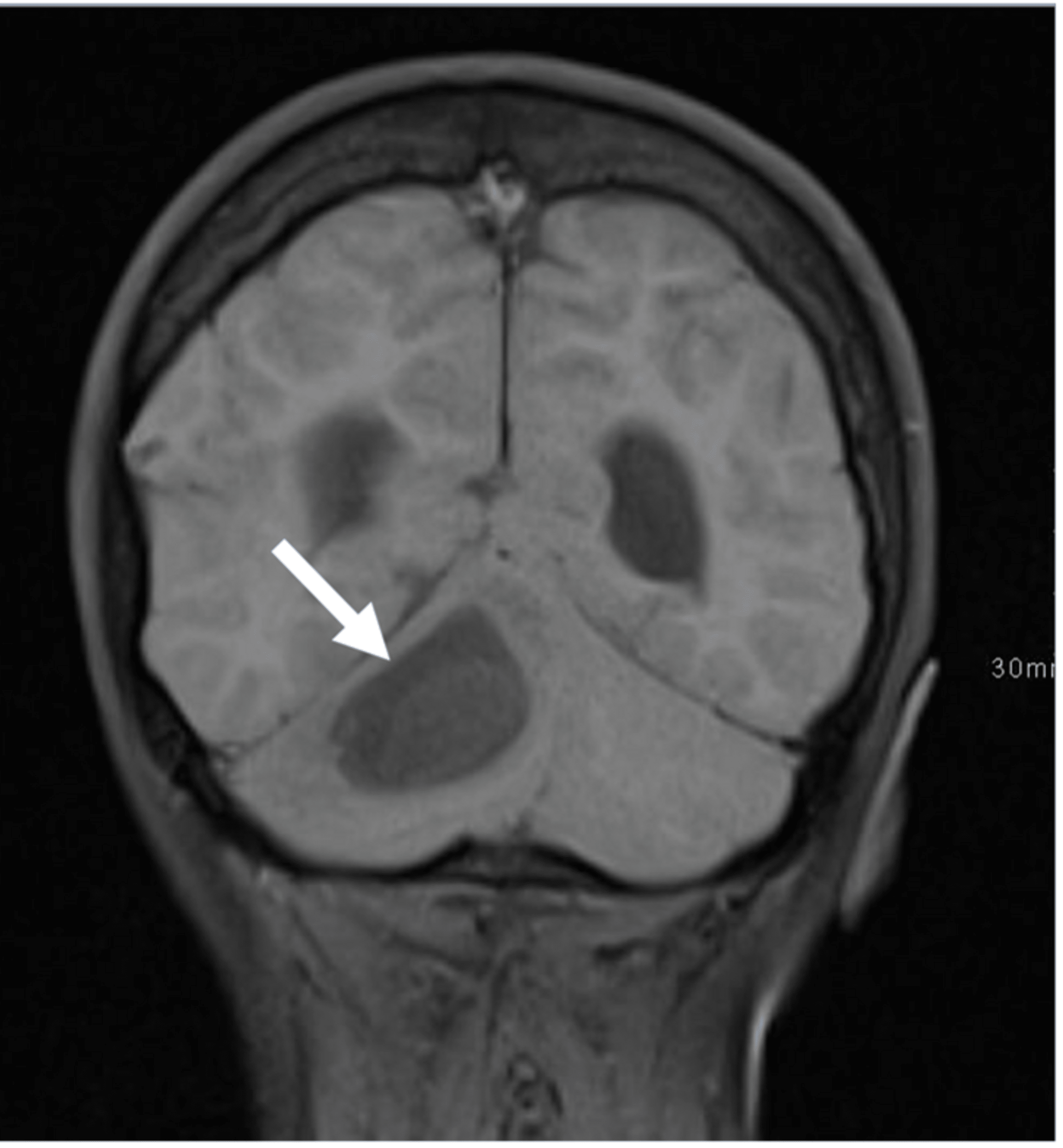 Cureus Dermoid Cyst In The Posterior Fossa Associated With Dermal Sinus And Abscess Formation 3114