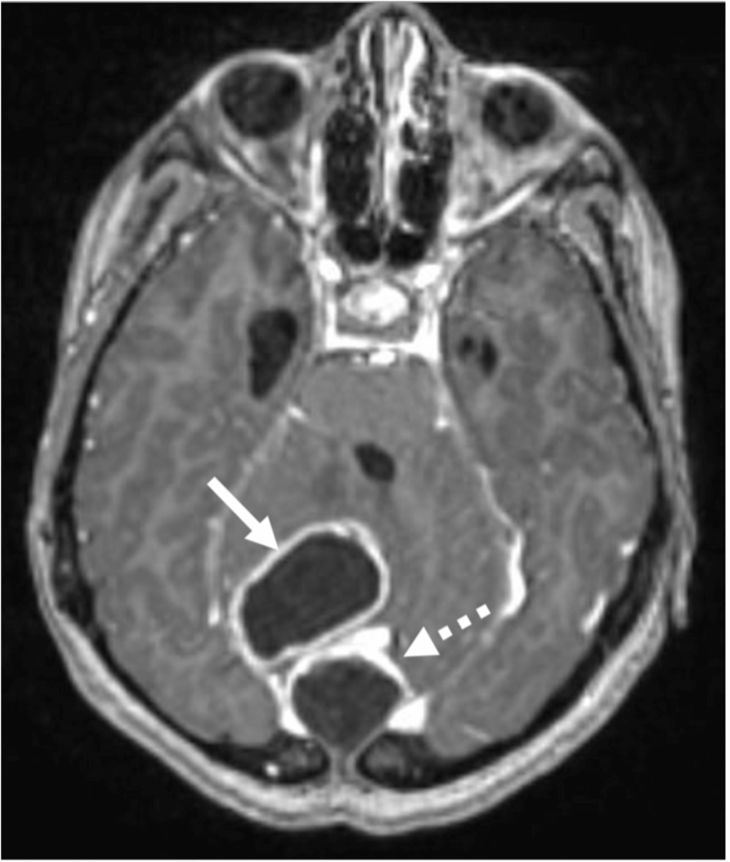 Cureus Dermoid Cyst In The Posterior Fossa Associated With Dermal Sinus And Abscess Formation 4220