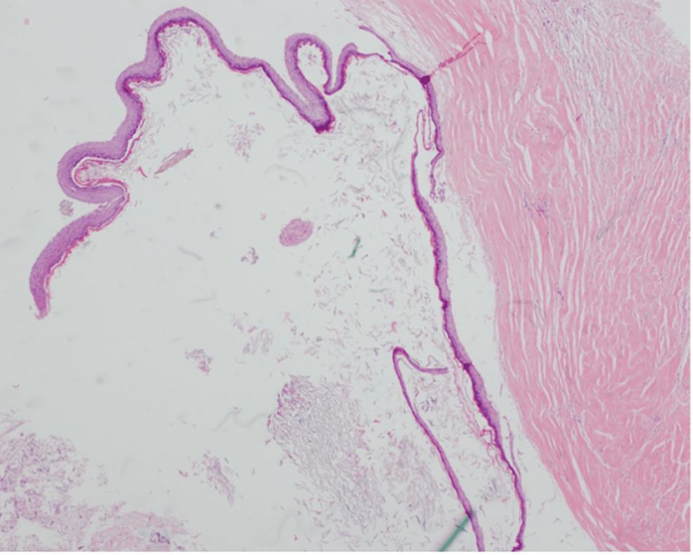 Cureus Dermoid Cyst In The Posterior Fossa Associated With Dermal Sinus And Abscess Formation 5185