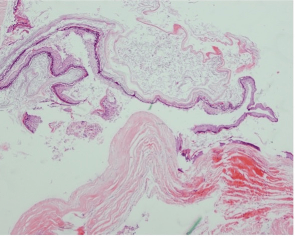 Cureus Dermoid Cyst In The Posterior Fossa Associated With Dermal Sinus And Abscess Formation 2806