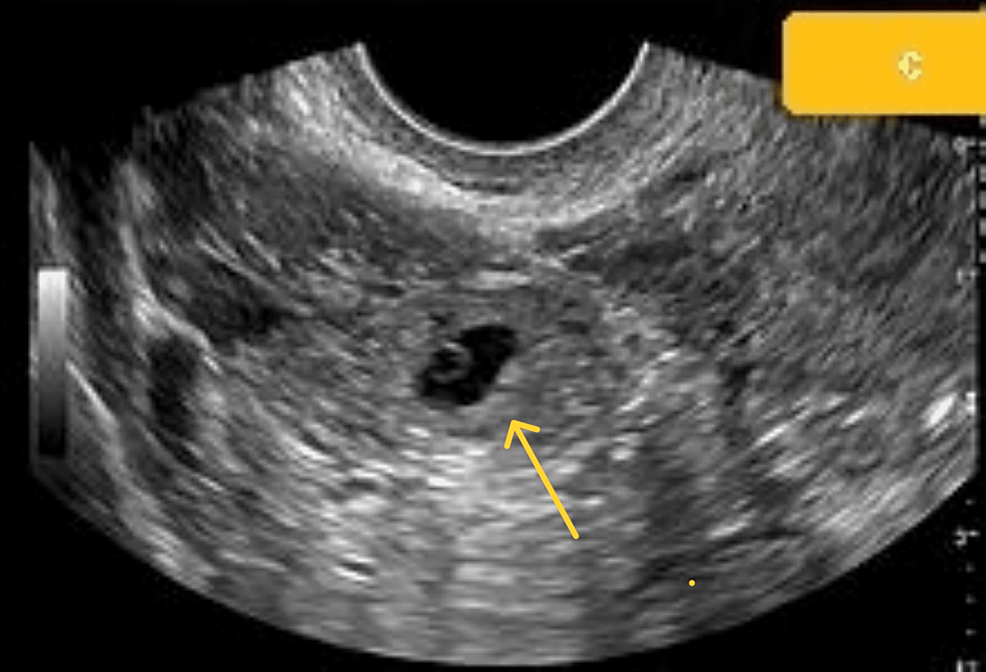 Cureus Rare Cesarean Scar Ectopic Pregnancy With Tubal Ectopic Pregnancy A Case