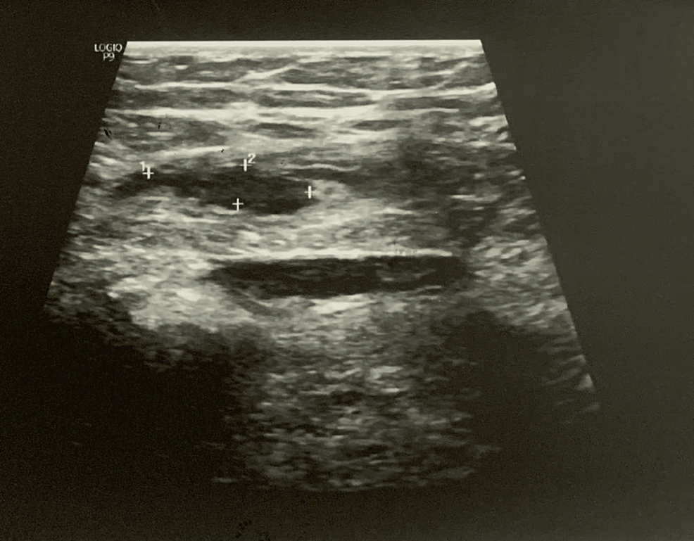 sonographic-detection-of-surgical-site-fluid-collections-and