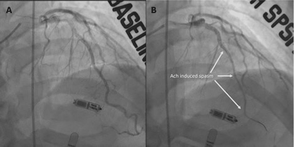 Update on Myocardial Bridging