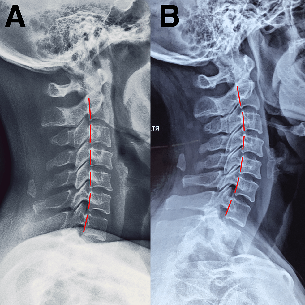 Cervicogenic Dizziness After SelfManipulation of the Cervical Spine
