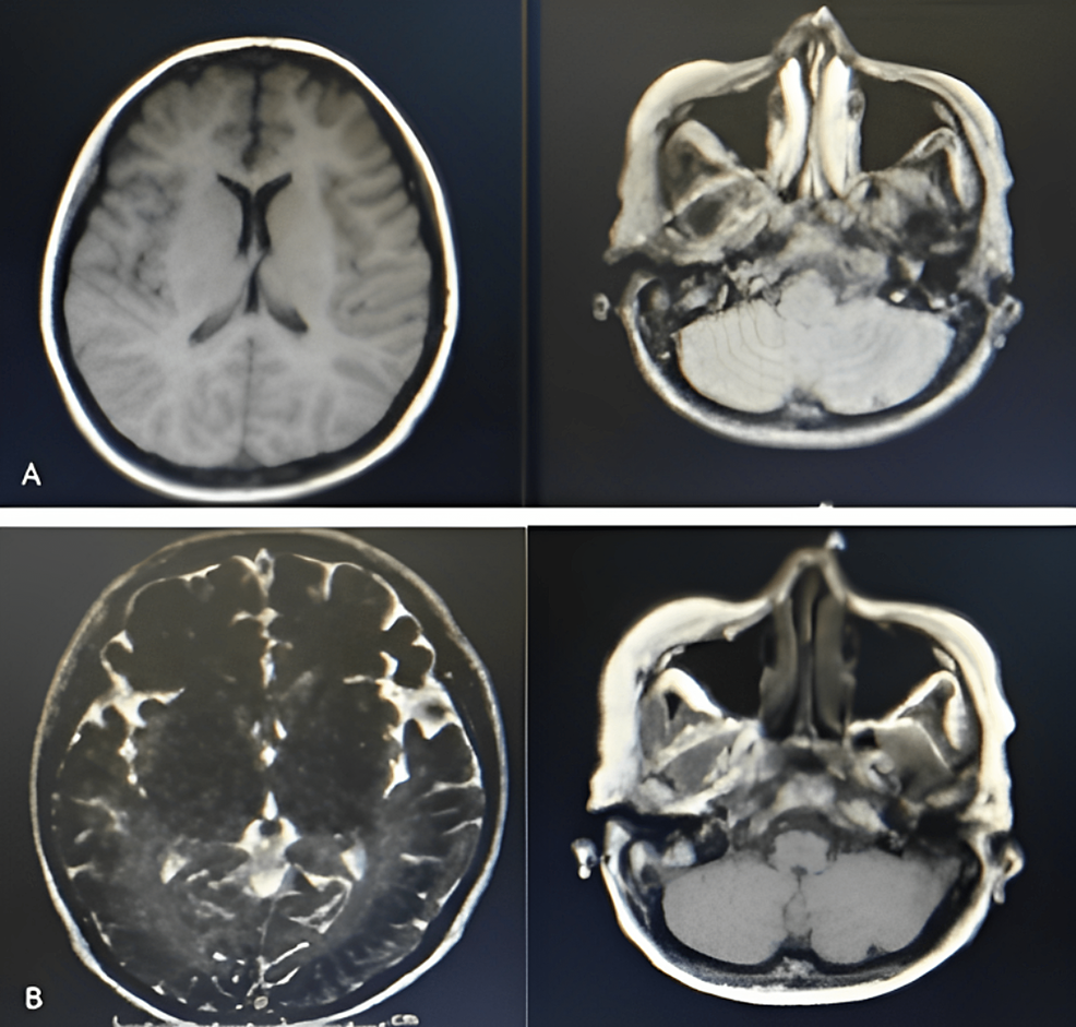 Subacute Sclerosing Panencephalitis