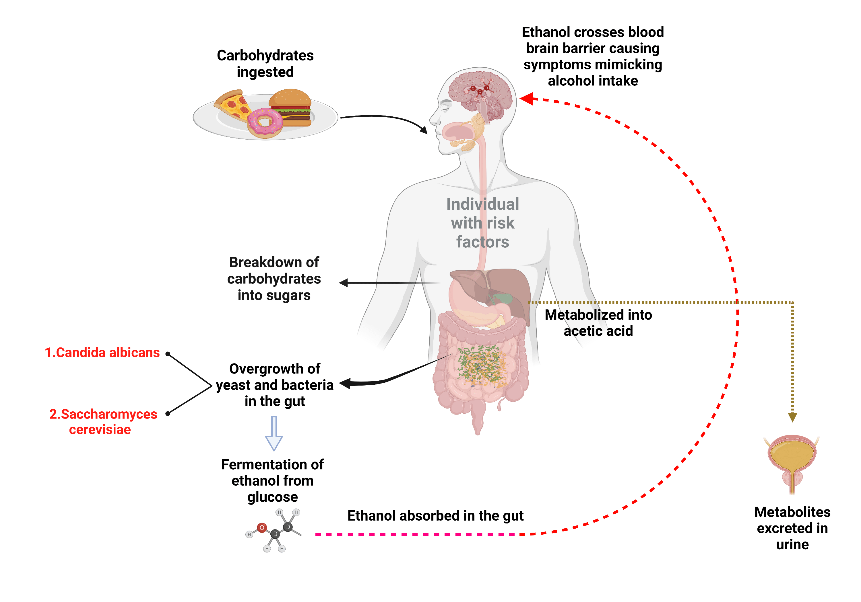 Cureus Understanding AutoBrewery Syndrome in 2023 A Clinical and Comprehensive Review of a