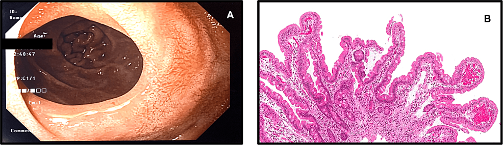 Cureus | Celiac Disease Is a Rare Cause of Benign Duodenal Stricture: A ...