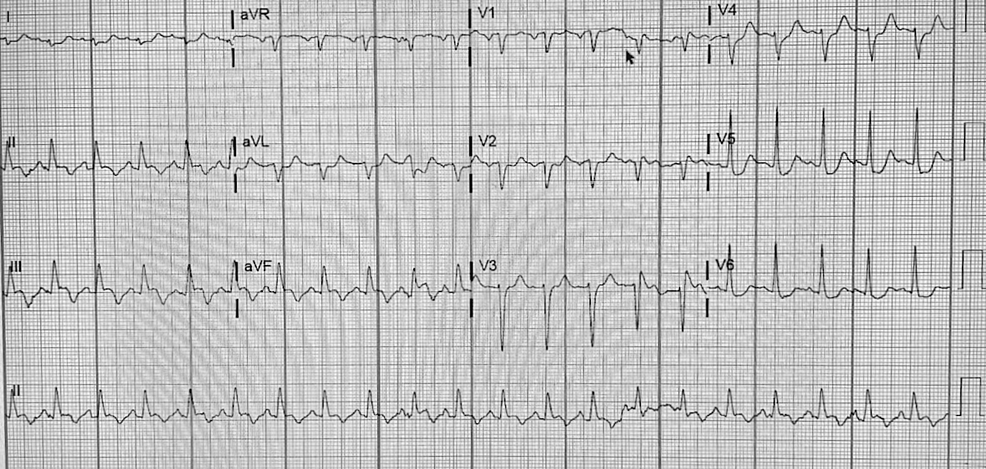 Report On Rare Complication Post Silent Myocardial Infarction 