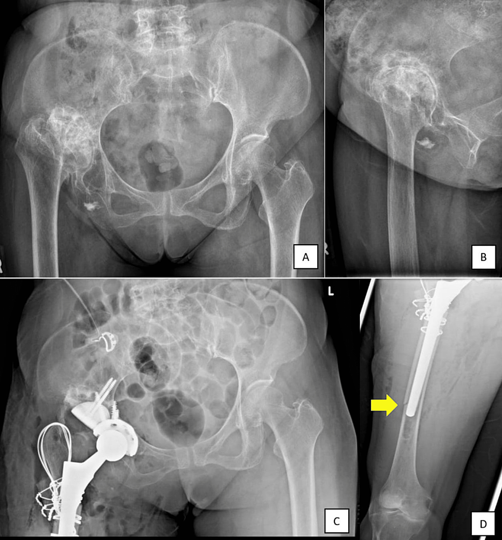 Evolution of mould arthroplasty of the hip joint.