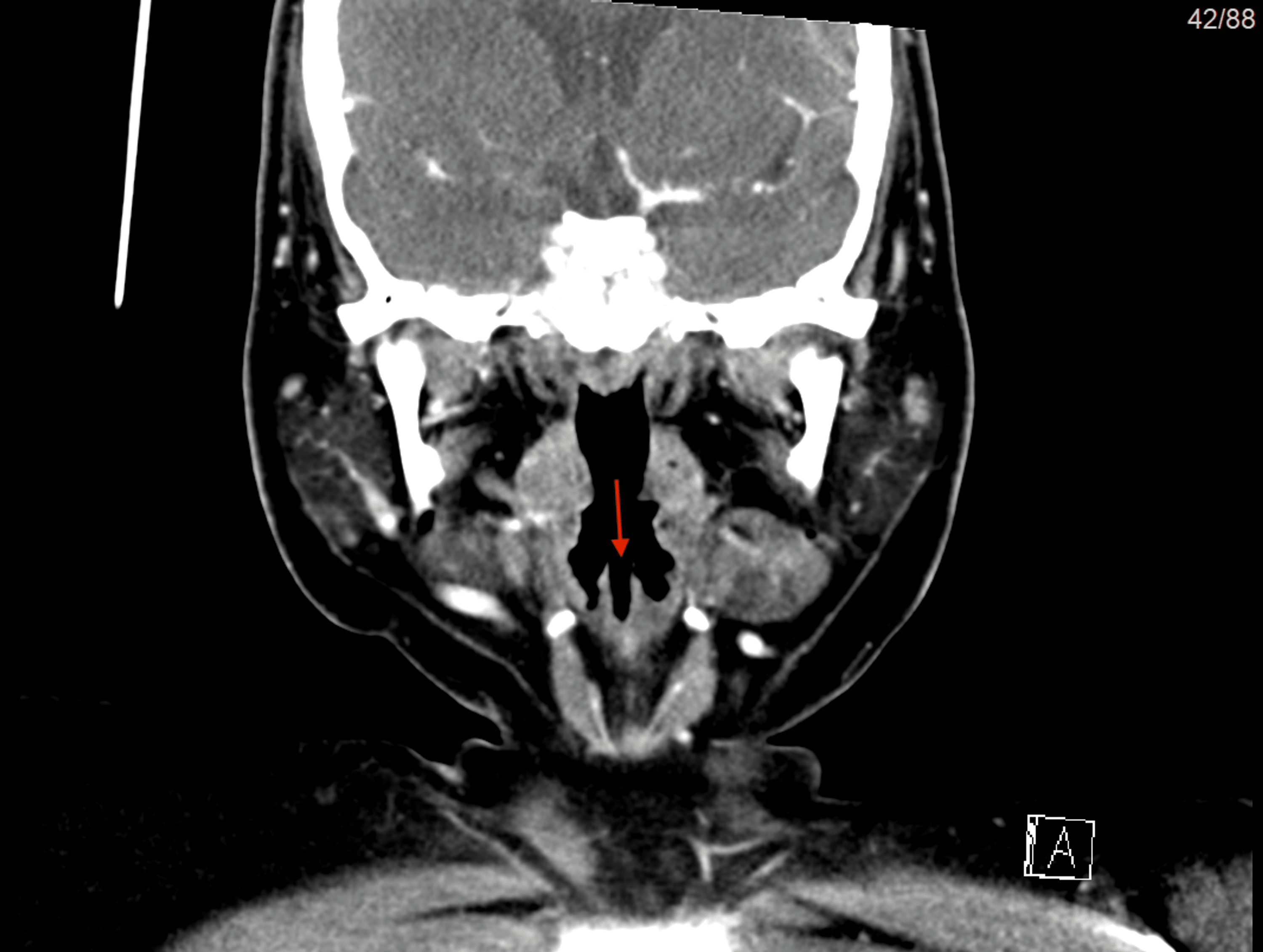 Bardet-Biedl Syndrome Presenting With Bifid Epiglottis: A Case Report ...