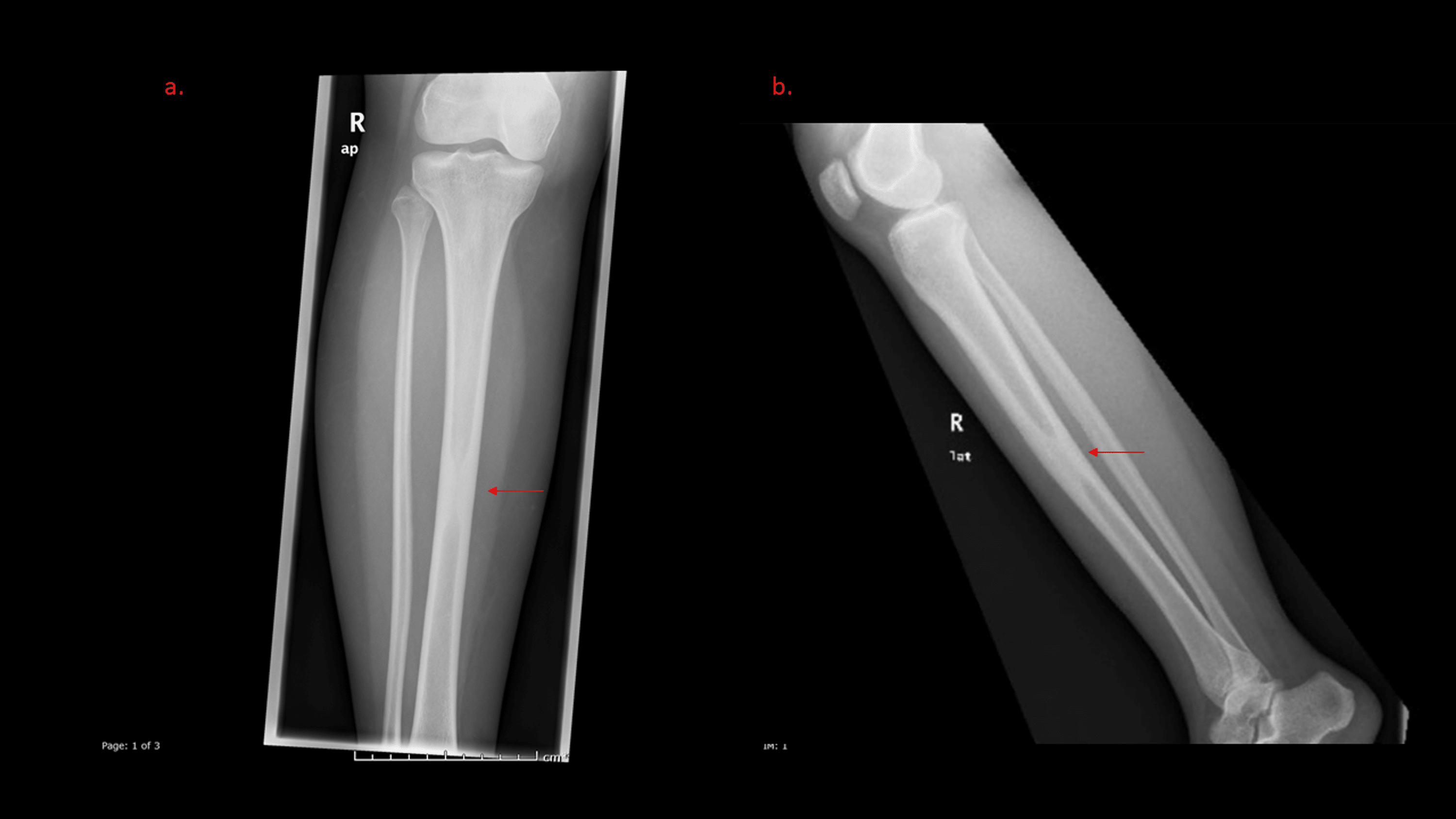Intramedullary Osteosclerosis of the Tibia A Rare Cause of