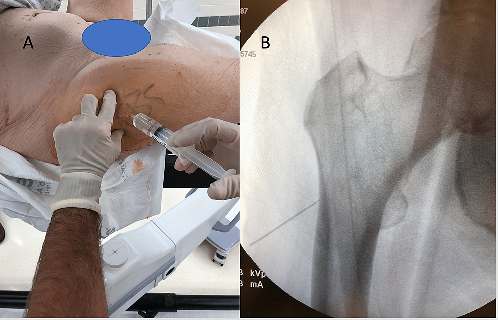 Local Anesthesia Approach for Percutaneous Screw Fixation of an
