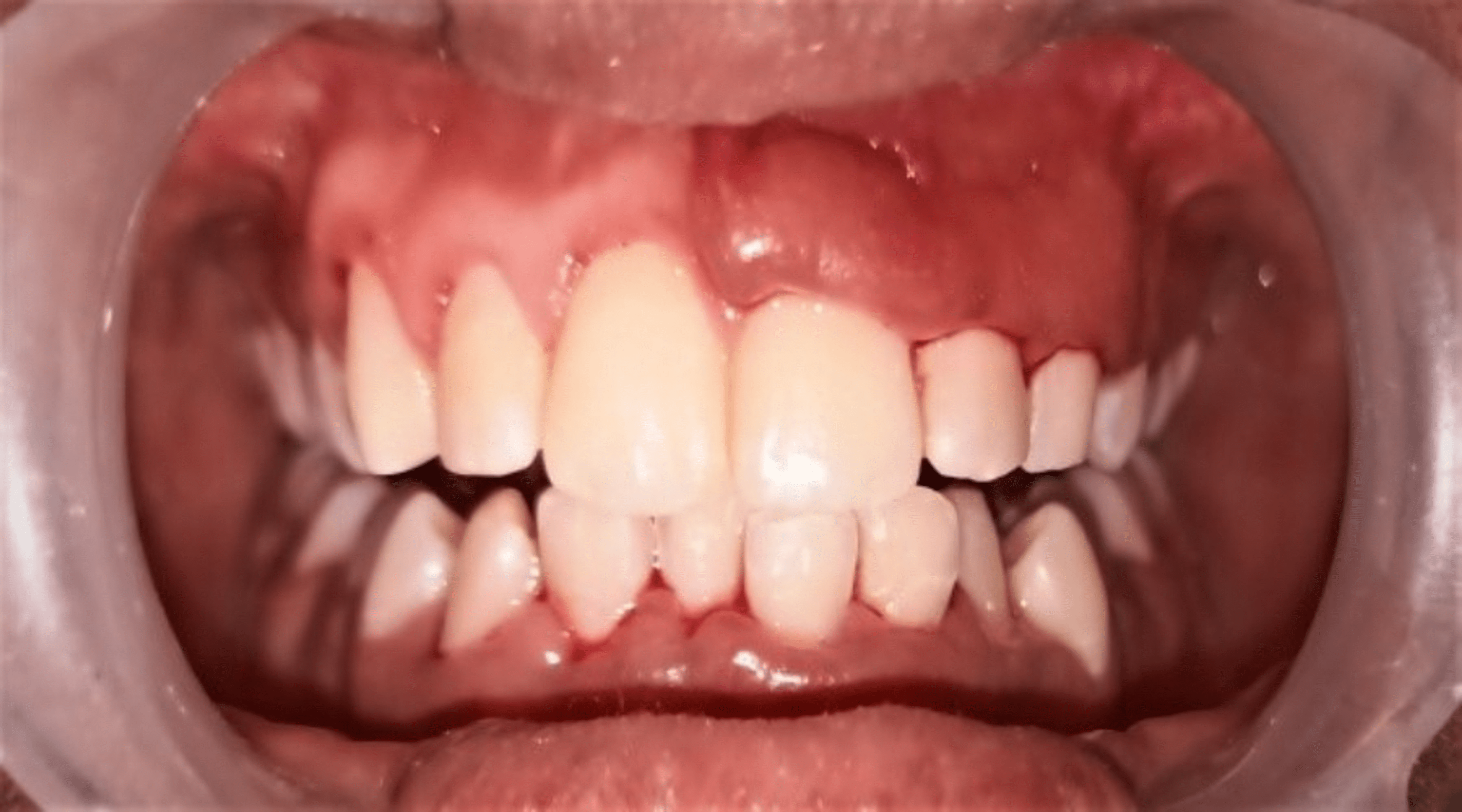 Cureus Vitamin D Deficiency and Gingival Enlargement A Case Report