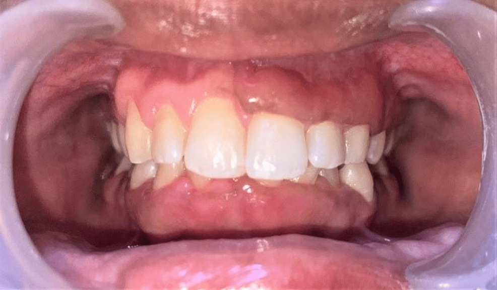 Cureus Vitamin D Deficiency and Gingival Enlargement A Case Report