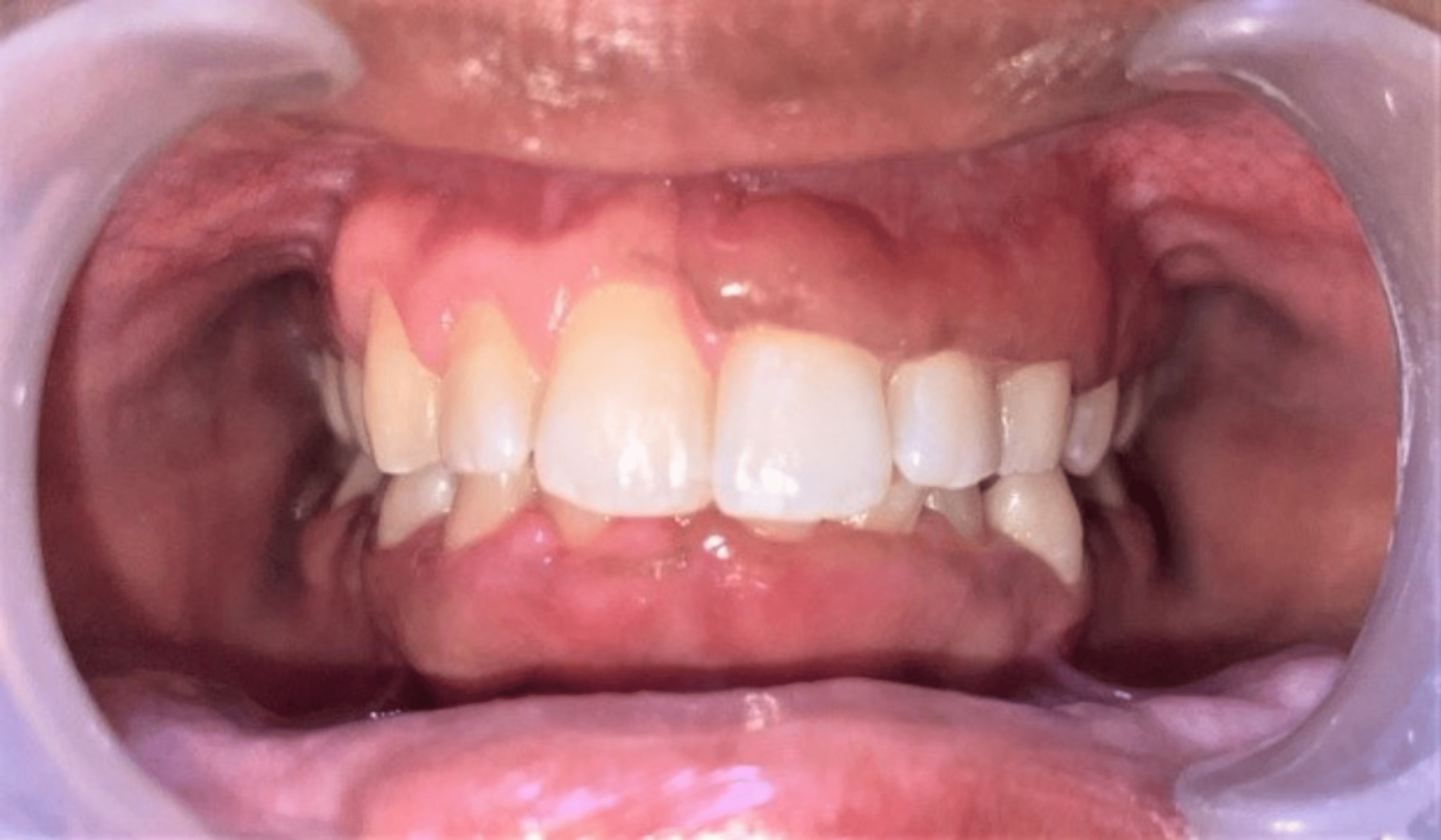 Cureus Vitamin D Deficiency and Gingival Enlargement A Case Report