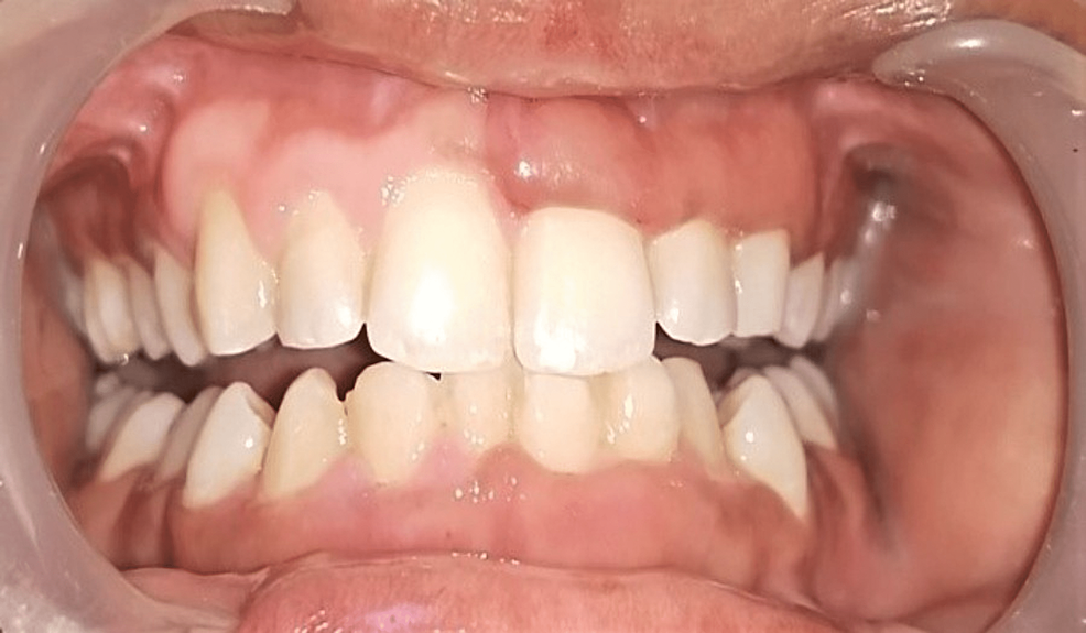 Cureus Vitamin D Deficiency and Gingival Enlargement A Case Report