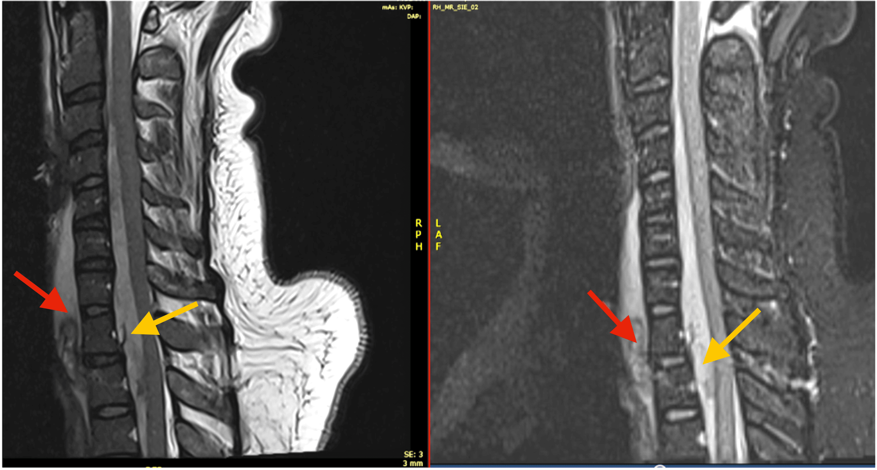 Traumatic Spinal Epidural Hematoma With Significant Neurologic Findings ...