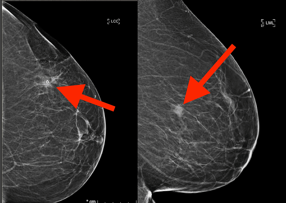 Lymphoepithelial Carcinoma of the Breast Treated With Partial ...