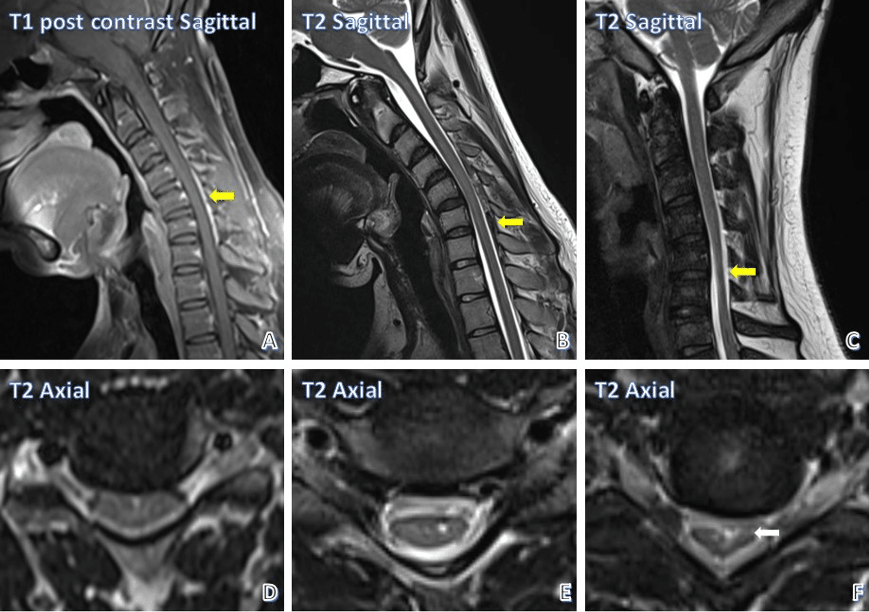 Cureus | Cervical Spine Magnetic Resonance Imaging Findings in Hirayama ...