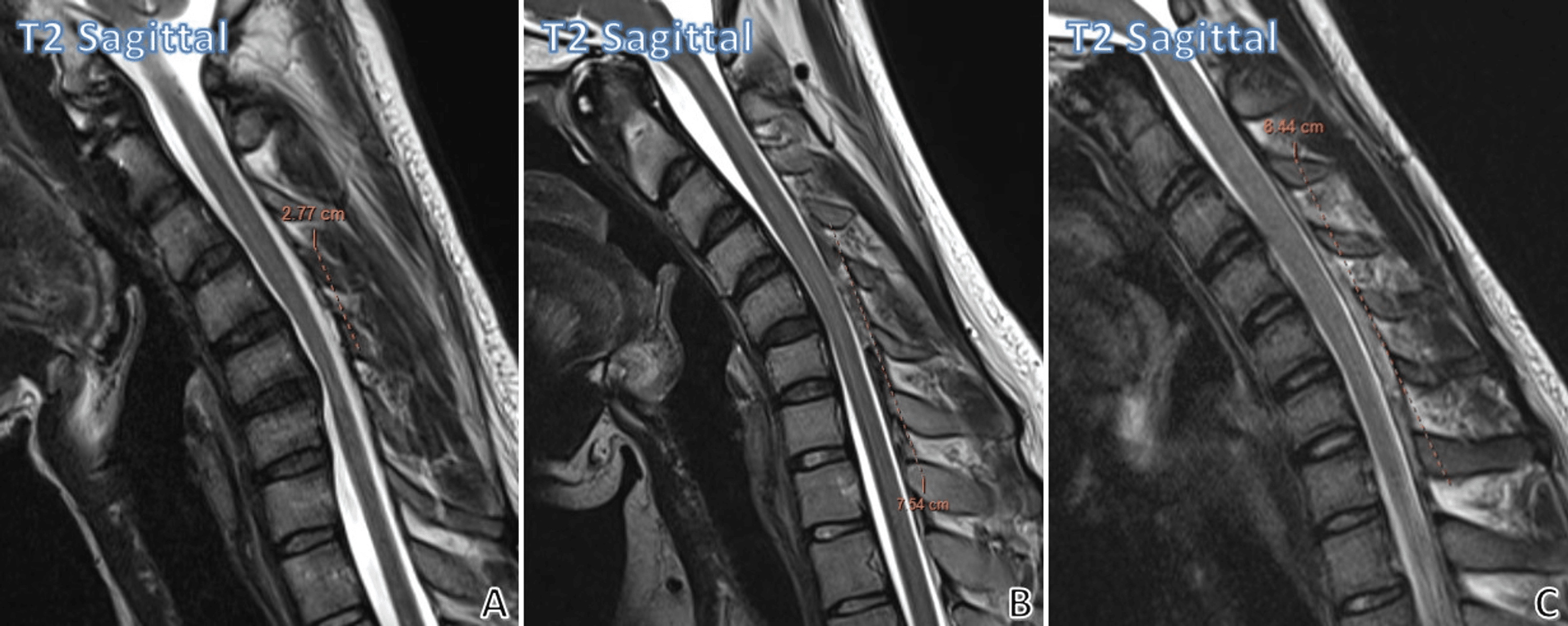 Cureus | Cervical Spine Magnetic Resonance Imaging Findings in Hirayama ...