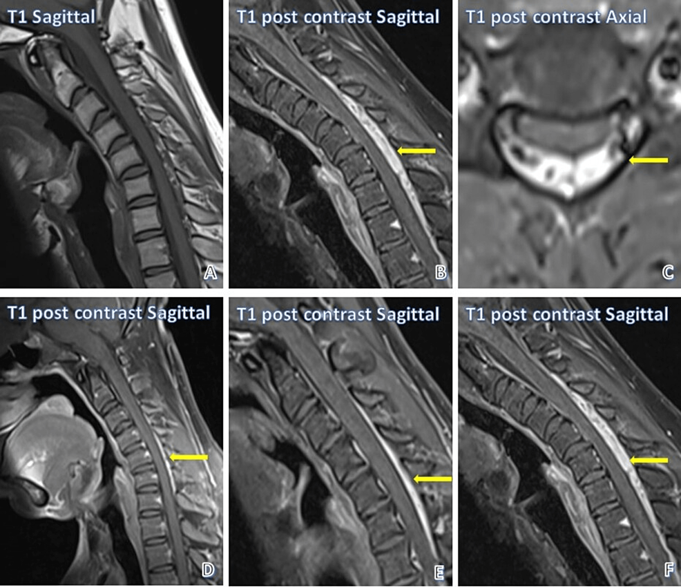 Cervical Spine Resonance Imaging Findings in Hirayama Disease