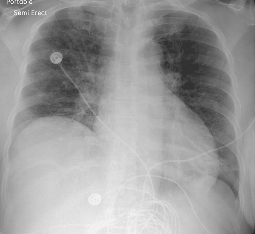 Cureus Acute Recreational CannabisInduced Hypersensitivity