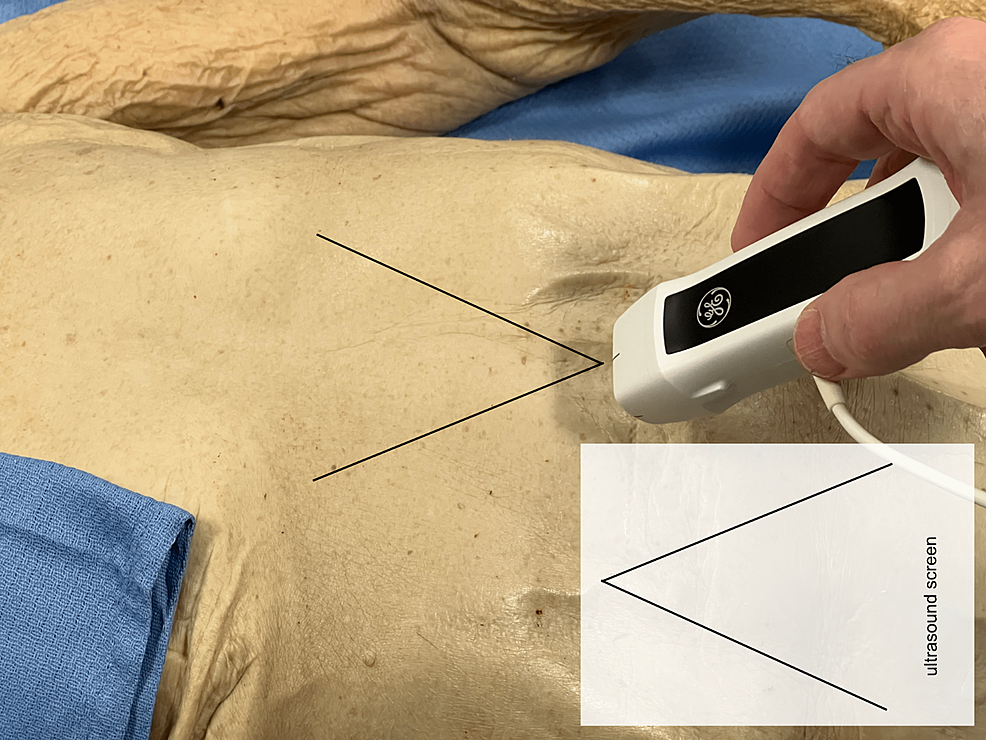 Anatomical Correlation For Focused Assessment With Sonography In Trauma ...