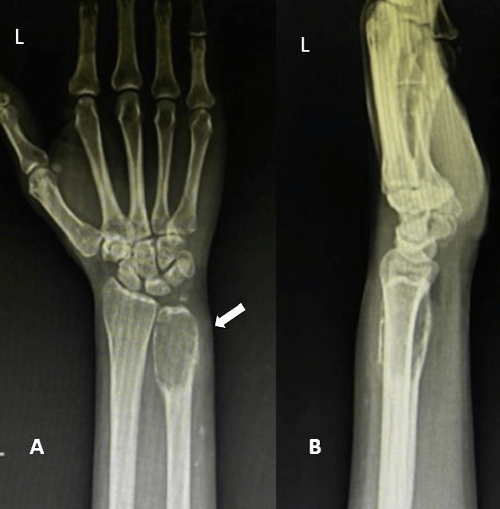 Giant Cell Tumor in the Distal End of the Ulna Managed by Darrach's  Procedure: A Case Report | Cureus, image size:986x1003