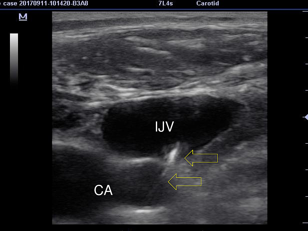 Cureus Where is the Guidewire? Confirmation of Central Catheter Placement in the