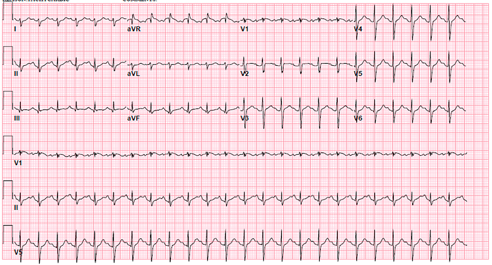 A Case of Right Ventricular Failure Secondary to Acute Chest Syndrome ...