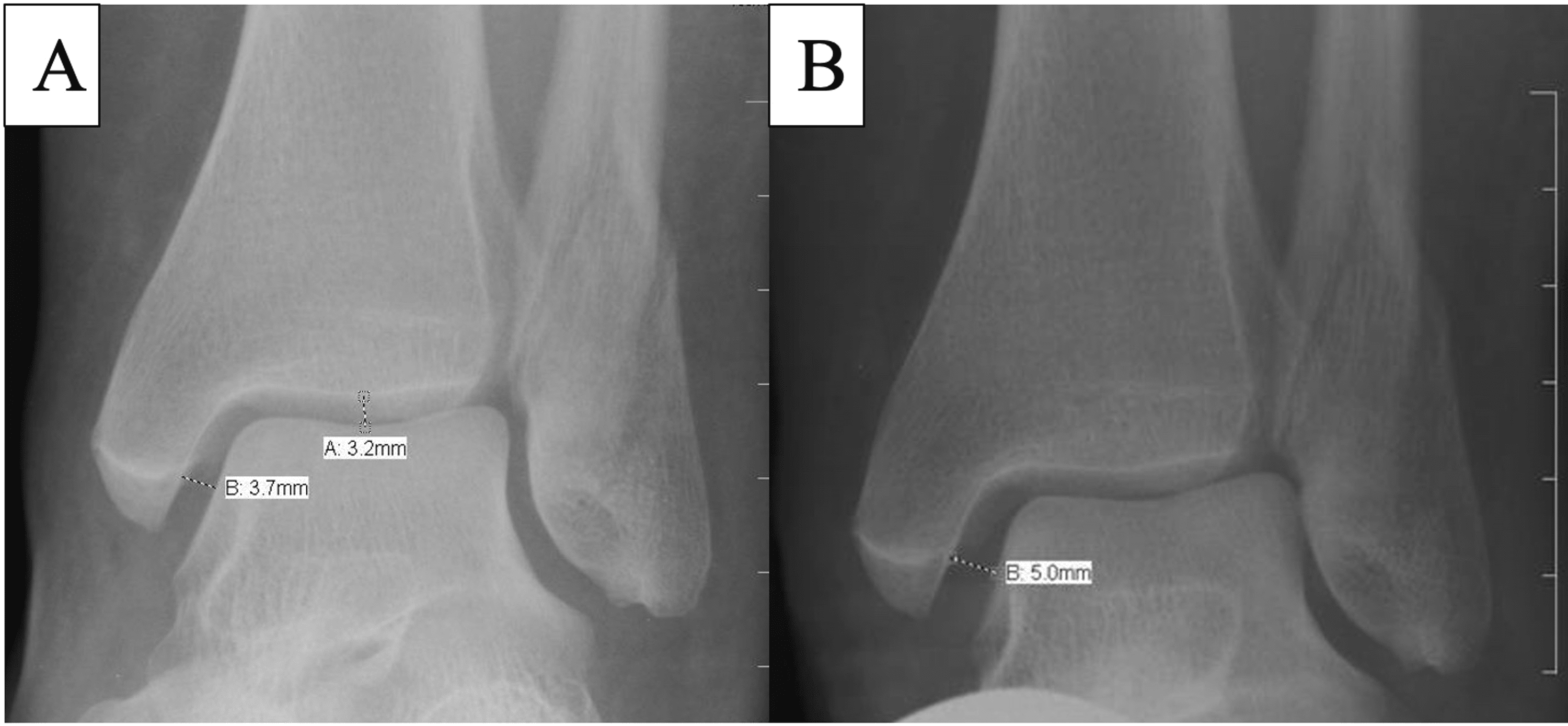 Indications And Interpretation Of Stress Radiographs In Supination ...