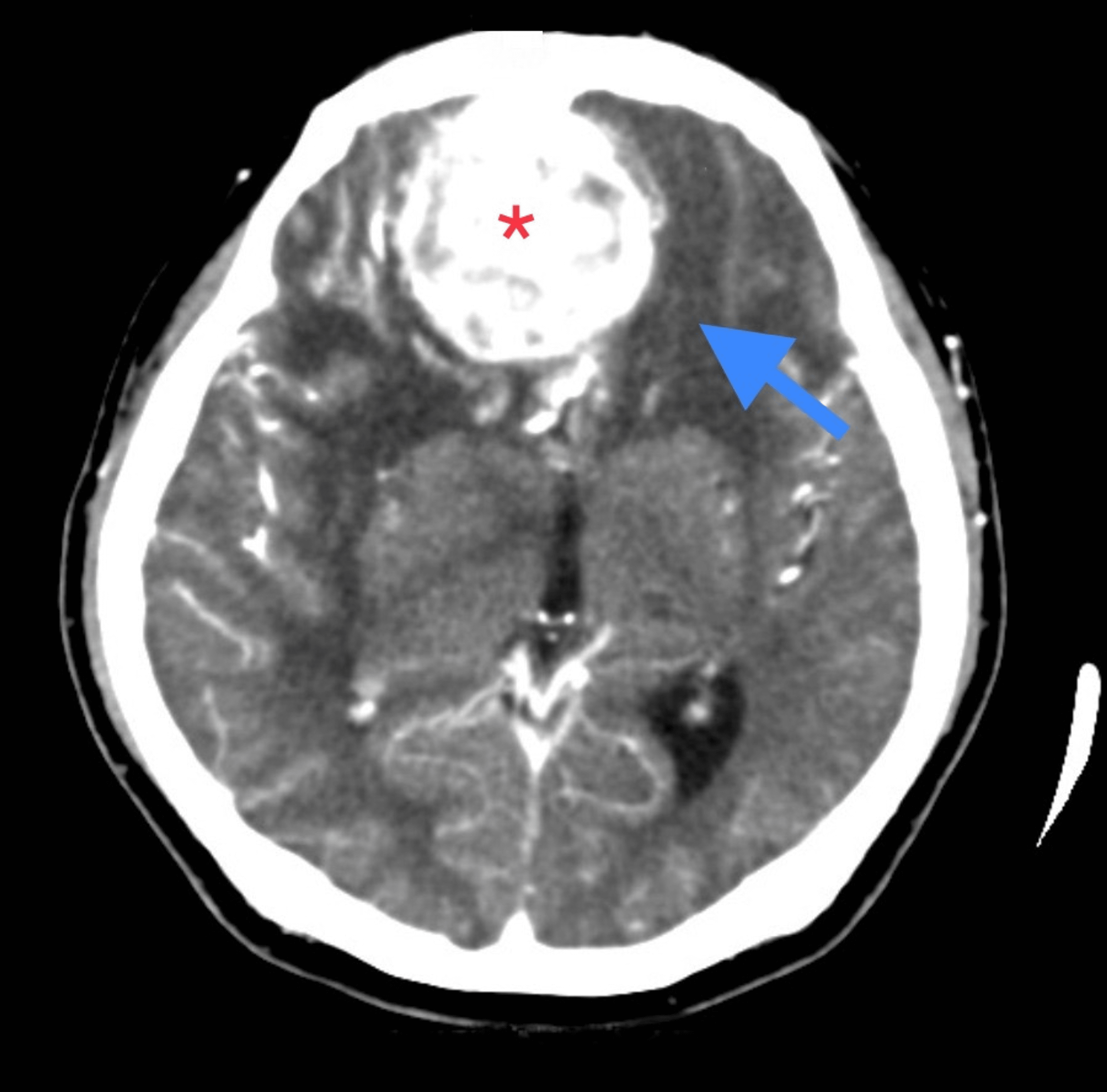 Cureus Visual Loss As Primary Manifestation of Olfactory Groove