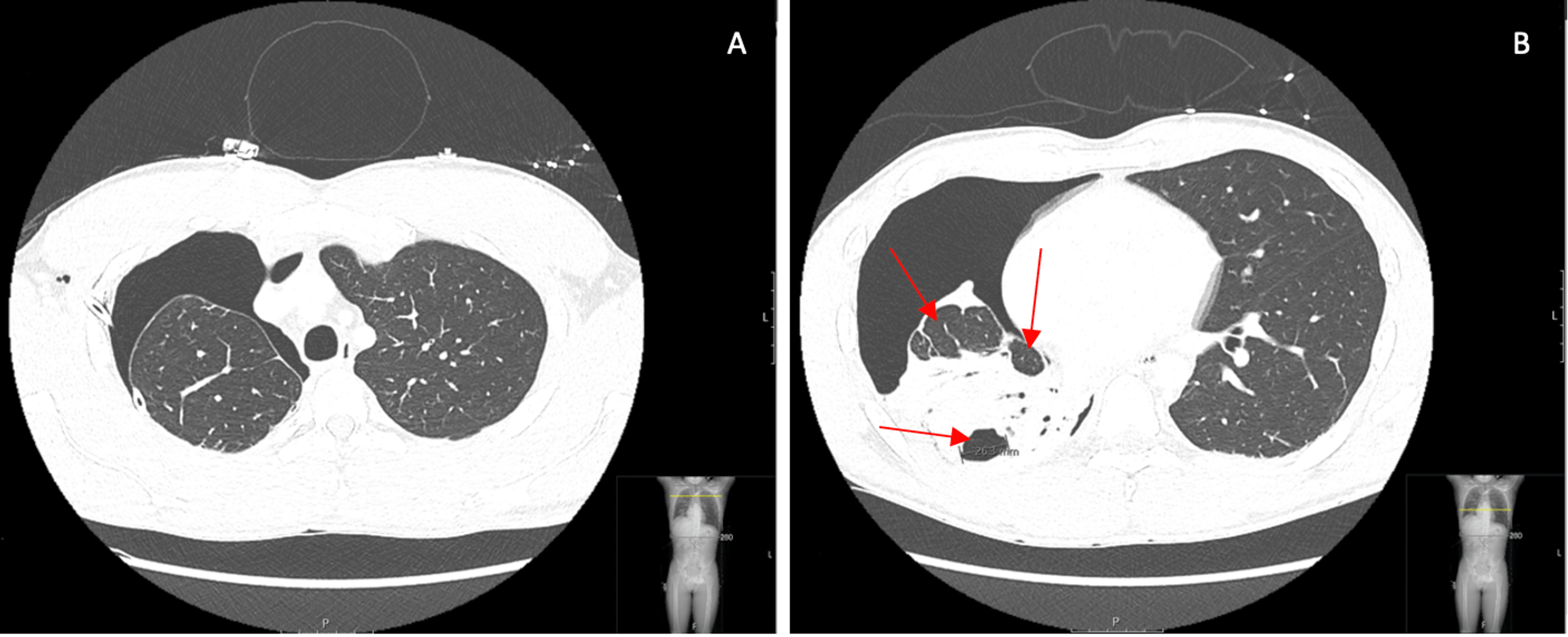 Cureus CoccidioidesInduced Pyopneumothorax in an Patient