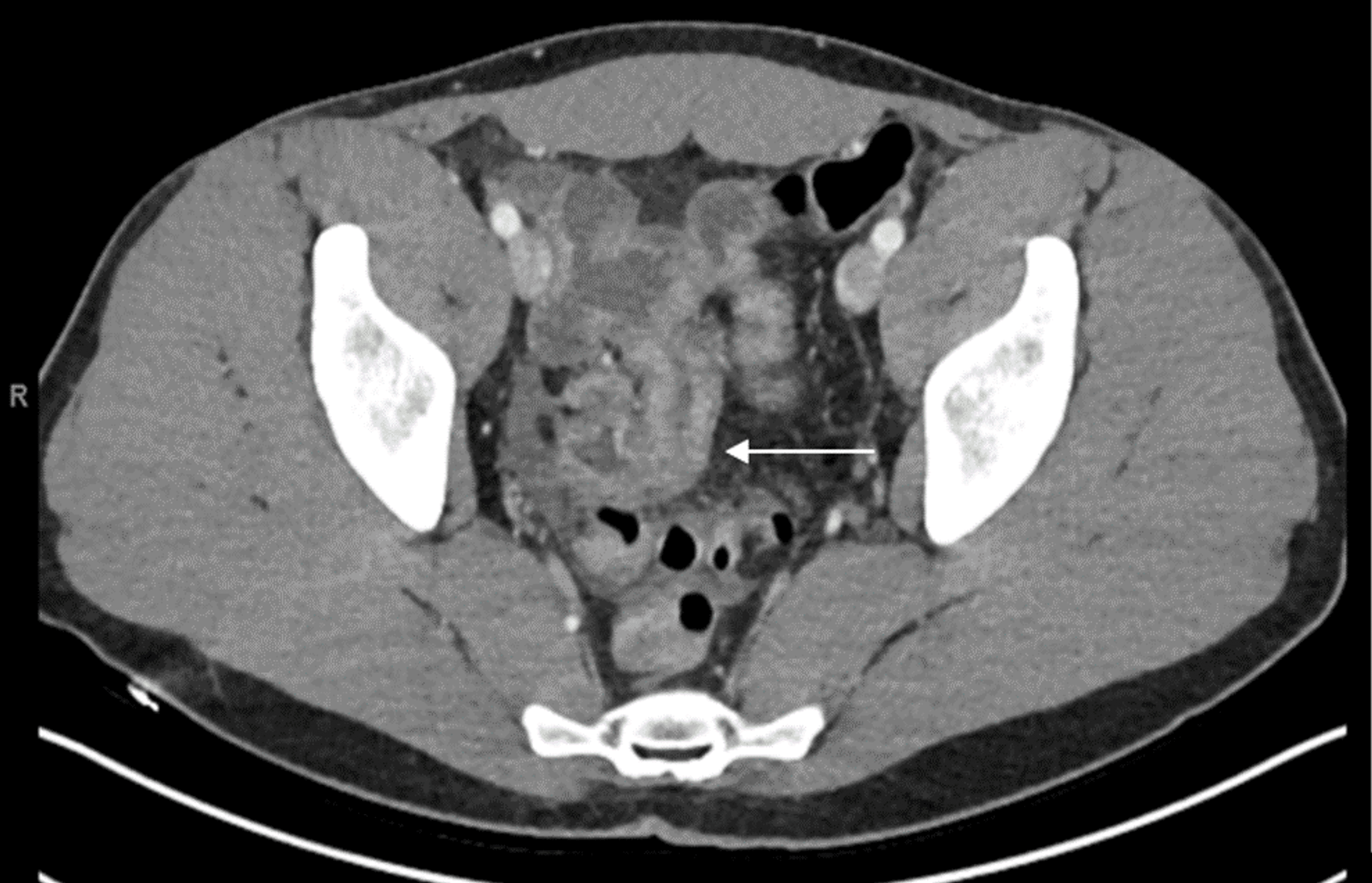 Cureus | Meckel’s Diverticulum Charading as Crohn’s Disease: A Single ...