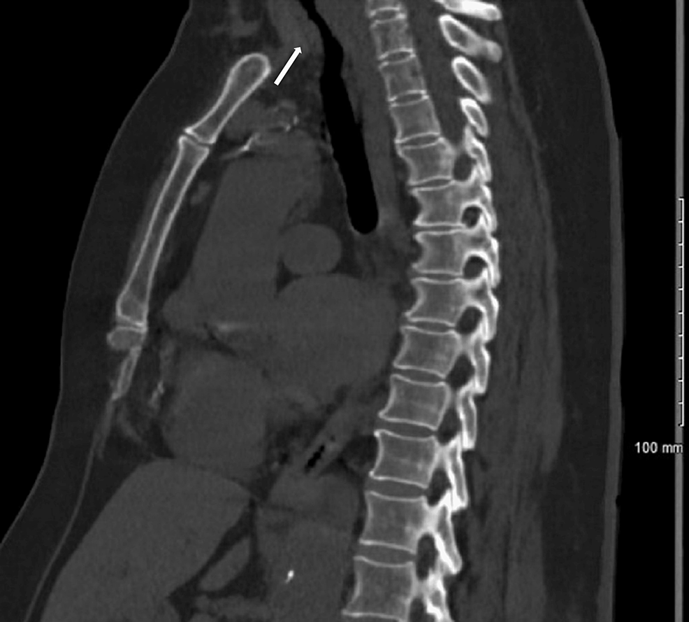 Cureus AngiotensinConverting Enzyme InhibitorInduced Angioedema