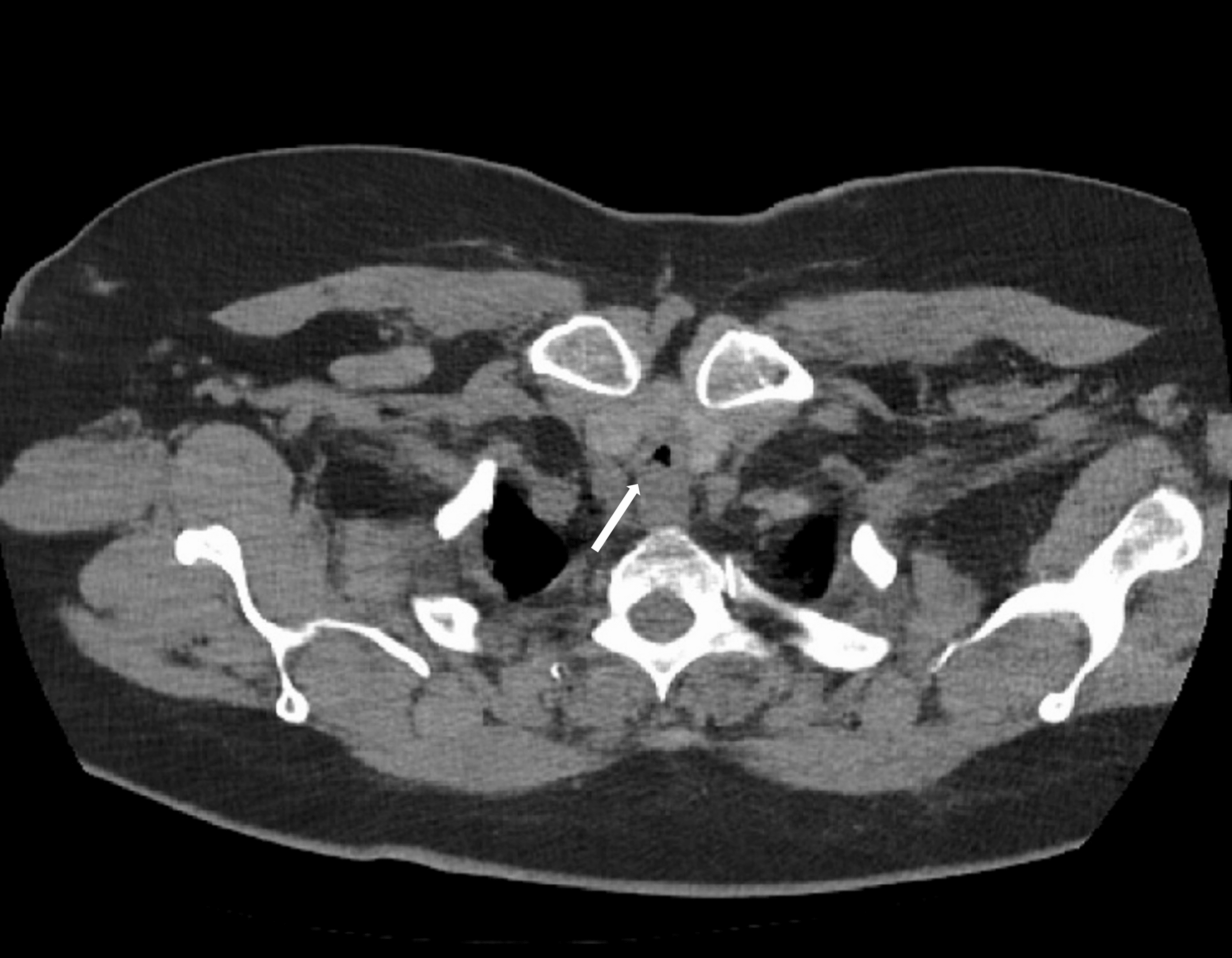 Cureus AngiotensinConverting Enzyme InhibitorInduced Angioedema