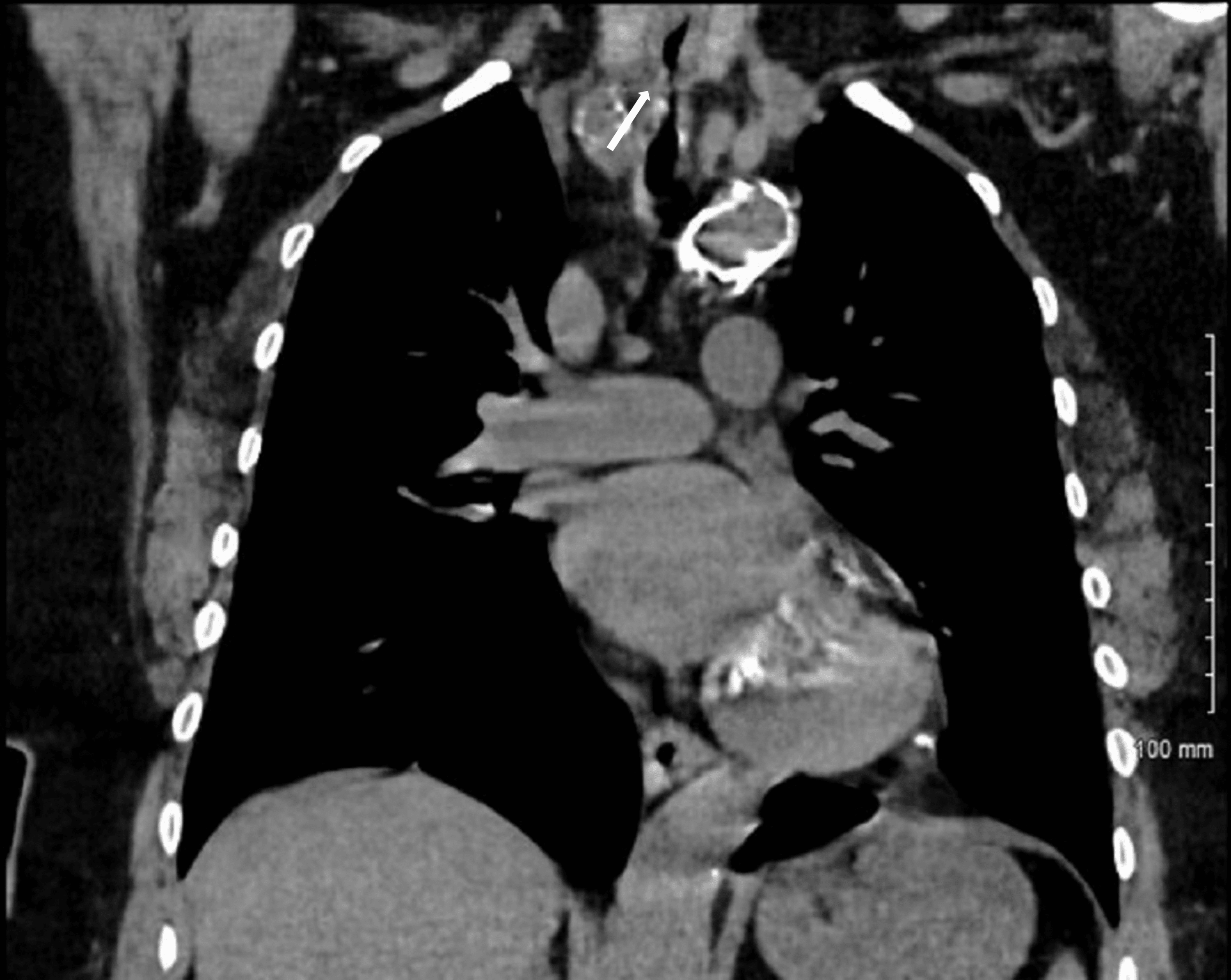 Cureus AngiotensinConverting Enzyme InhibitorInduced Angioedema
