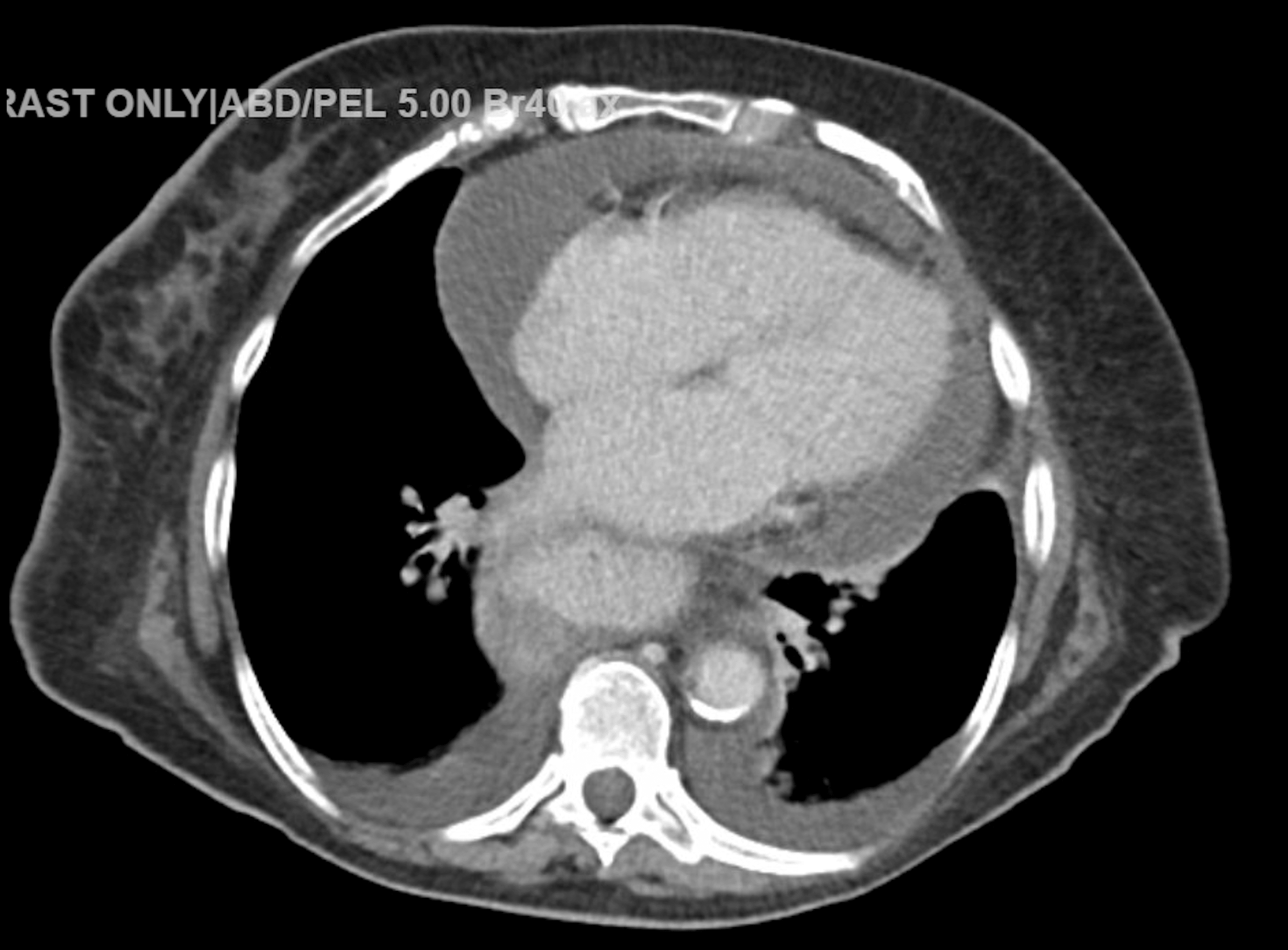 Imatinib Induced Pleuro Pericardial Effusion And Atrial Fibrillation An Unusual Side Effect