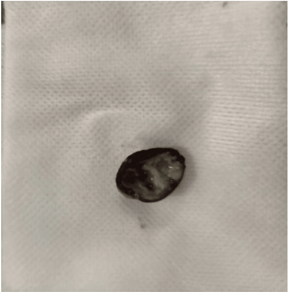 Cureus A Case of Occult PistachioShell Endobronchial Foreign Body
