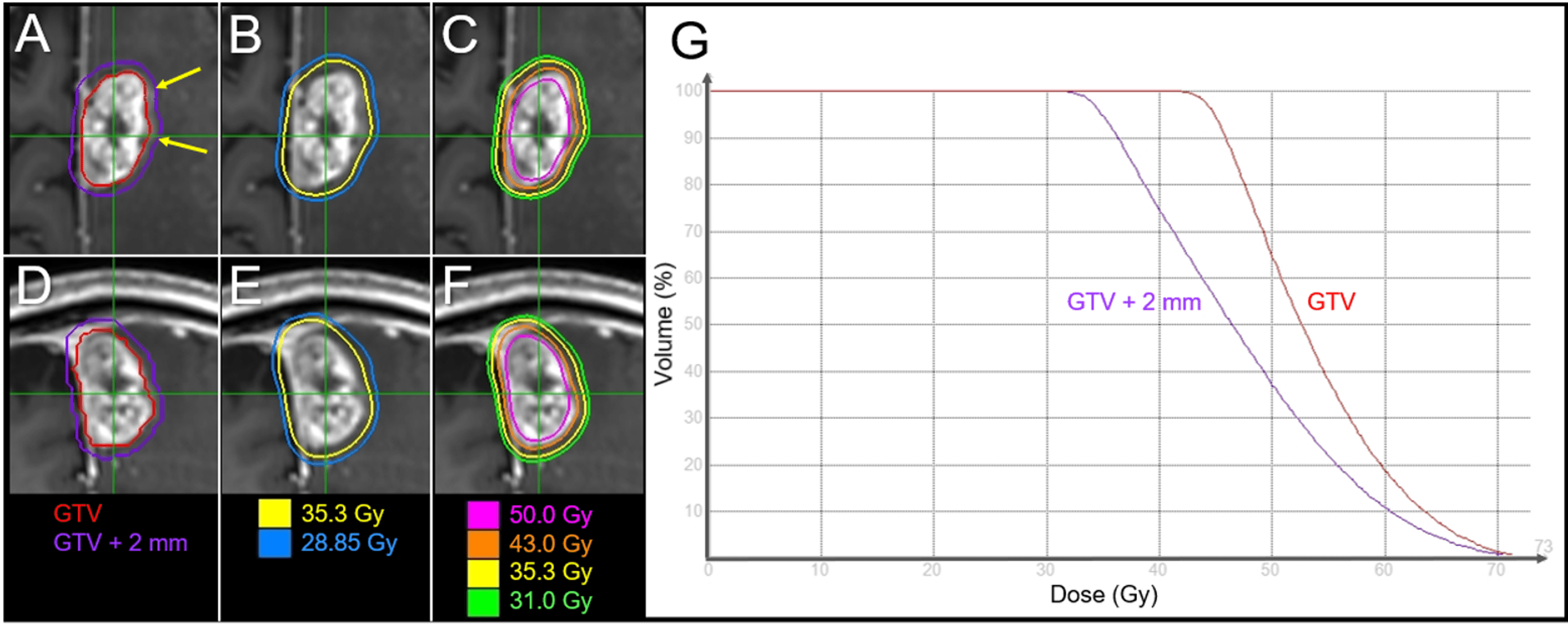 Cureus Local Control Failure After FiveFraction Stereotactic