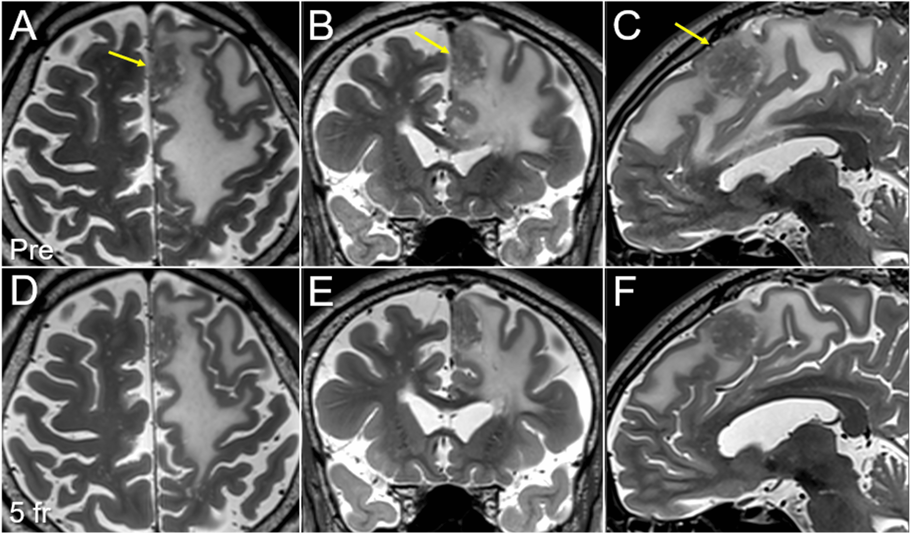 Cureus Local Control Failure After FiveFraction Stereotactic