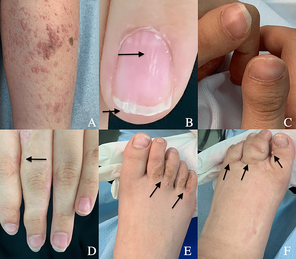 Focal Dermal Hypoplasia Associated With Lymphedema A Case Report From Saudi Arabia Cureus