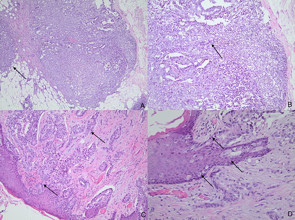 Cureus Rare Paget’s Disease Associated With Breast Cancer in a 70