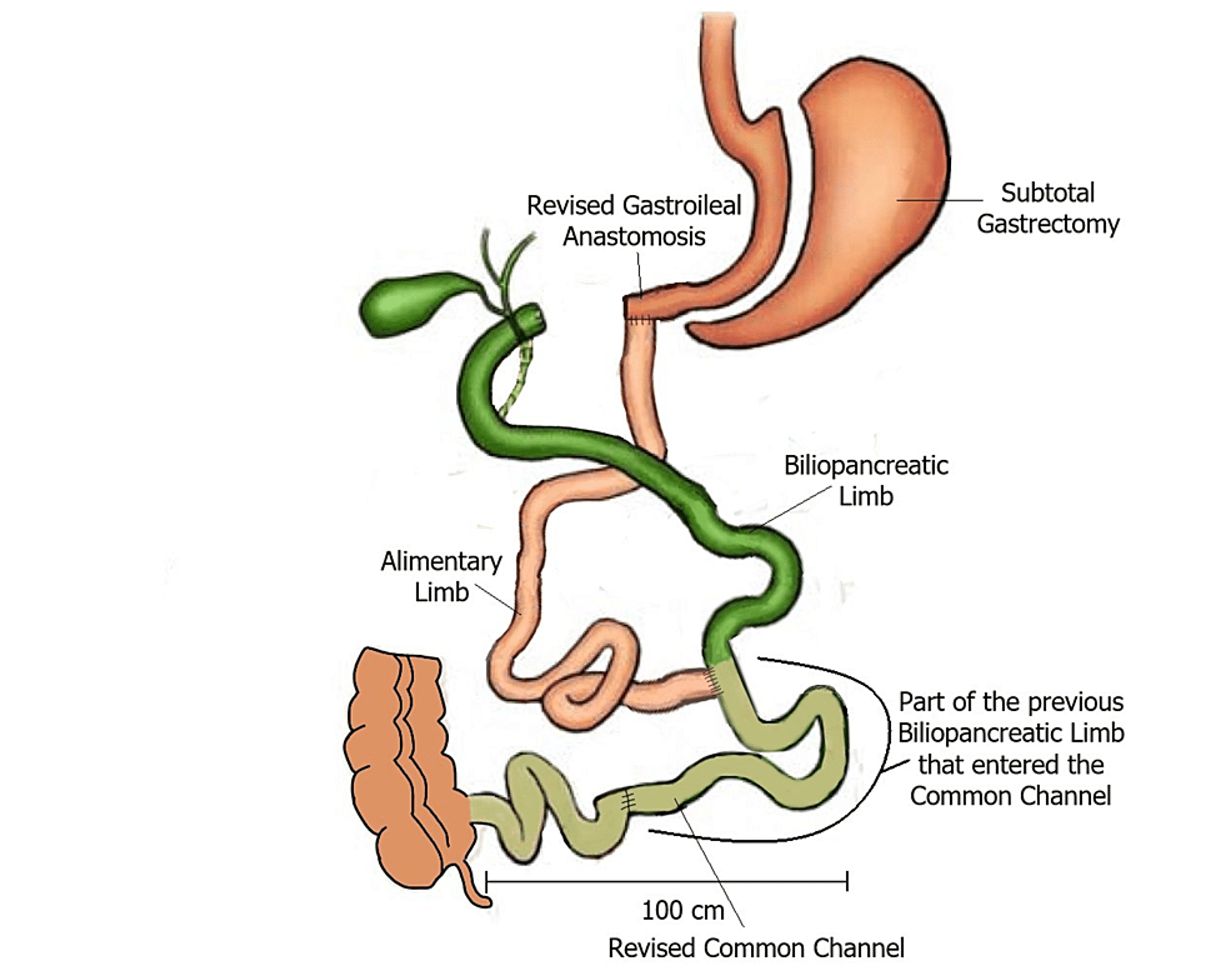 Cureus | Bacterial Translocation as a Source of Postoperative Fever ...